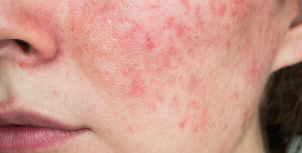 Rosacea